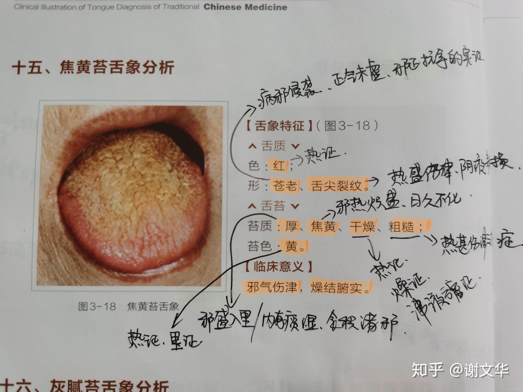 焦黄苔舌象分析