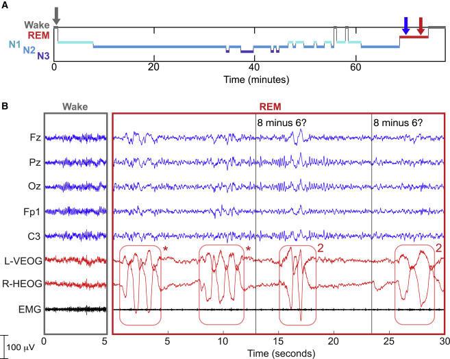 医学上,有一种脑电图可用于睡眠和梦境研究及抑郁症,睡眠呼吸暂停综合