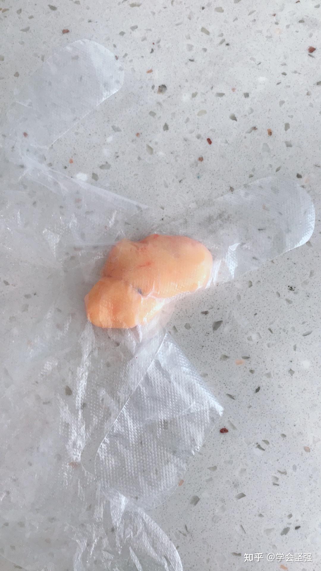 大腿内侧的脂肪瘤