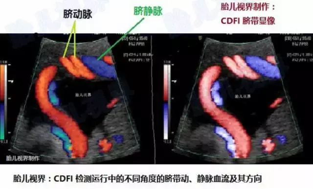 横向部分显示出一根粗大的蓝色脐静脉,二根细窄的桔红色的脐动脉并行