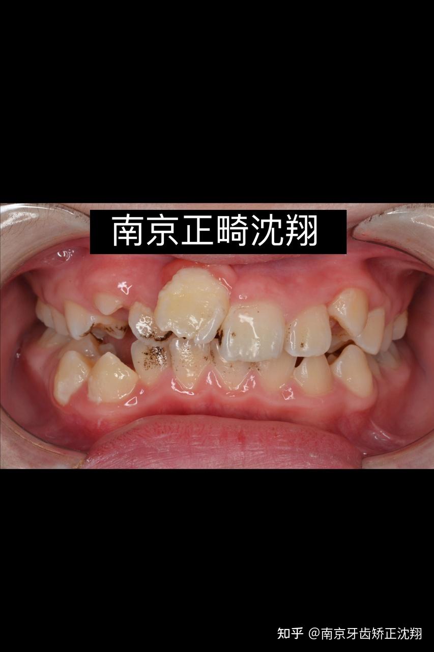 南京整牙拯救重度乱牙正畸重建少年全口环境