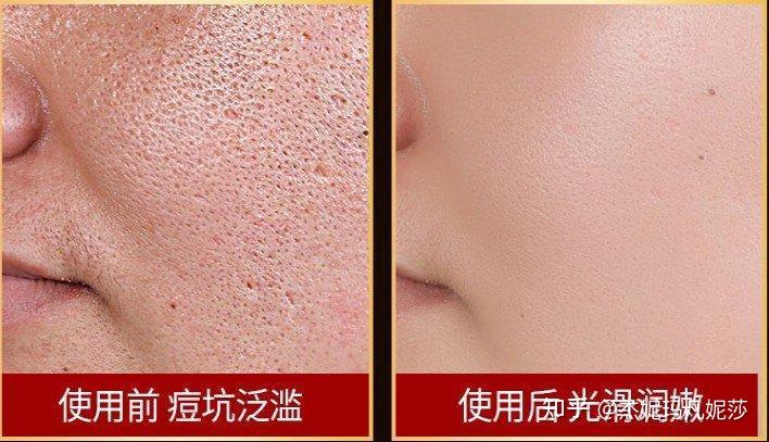 兴义祛痘：从皮肤困扰到美丽蜕变的秘籍探索