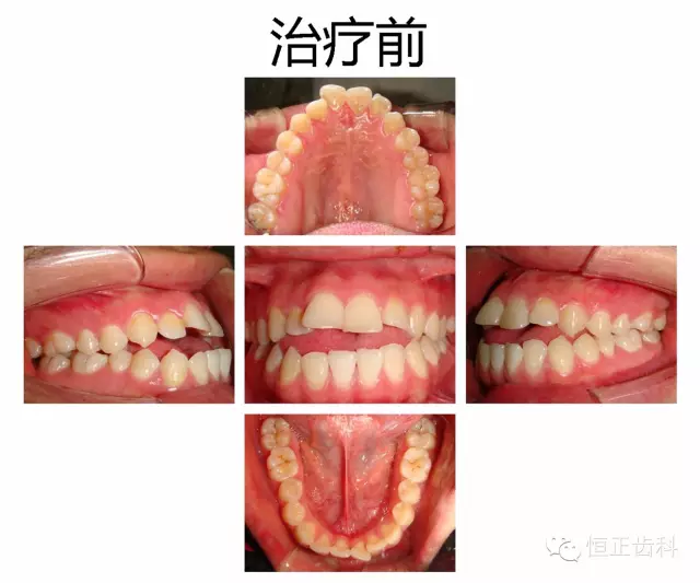 反合、开合、偏合的矫正 - 知乎