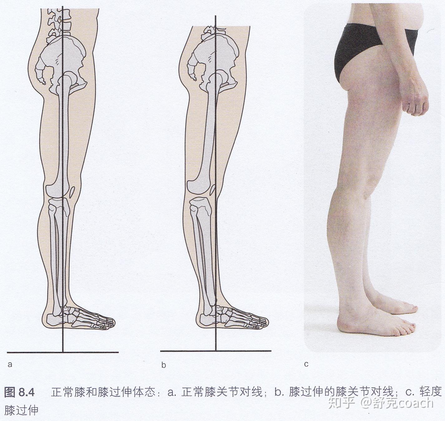 【干货】：如何改善膝过伸（膝超伸）？ - 知乎