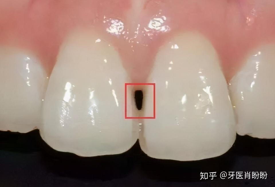 会在吃饭时容易塞牙并且影响美观,尤其是门牙,呲牙一笑黑三角就明显