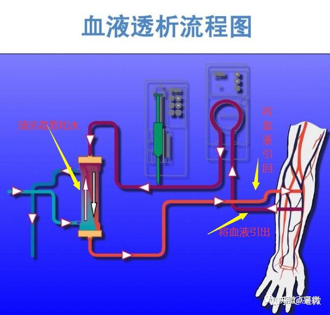 血液透析滤过原理图图片