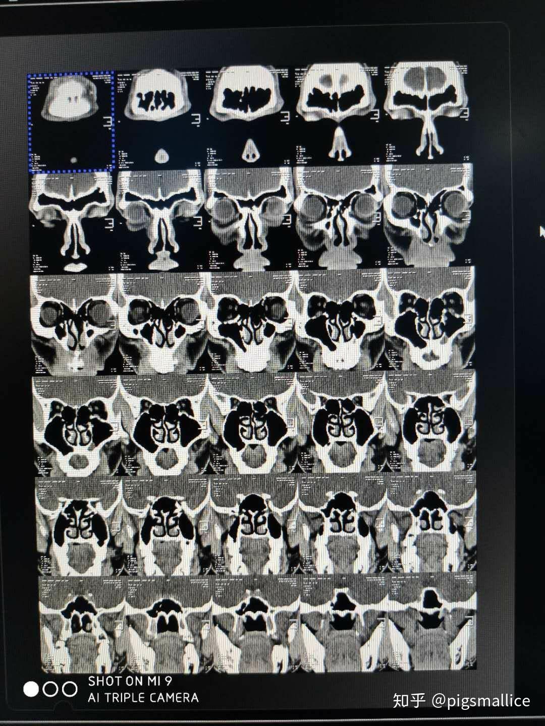 副鼻窦ct检查发现上颌窦有两个囊肿怎么办求助