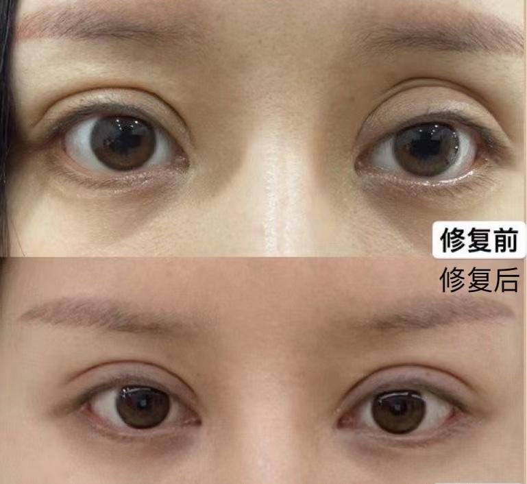 国内有哪些眼修复好的医生做双眼皮一年了还有肉条感还能修复吗