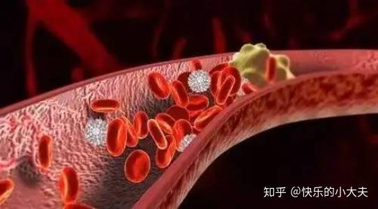 什么是静脉血栓 静脉血栓好治疗吗 知乎