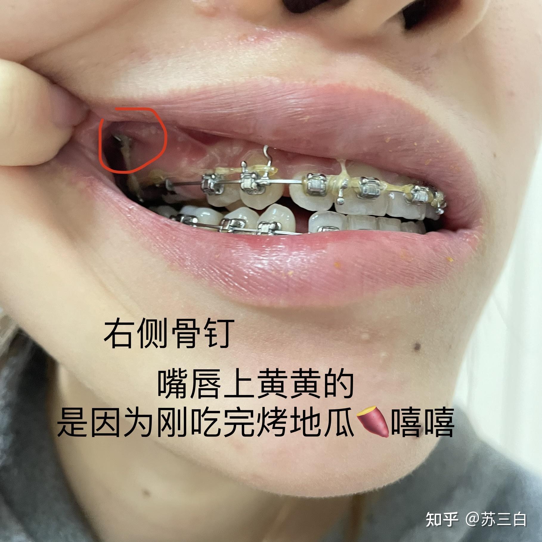 口腔上顎打了兩個骨釘打骨釘感受:除了感覺貴沒什麼其他感受 一顆