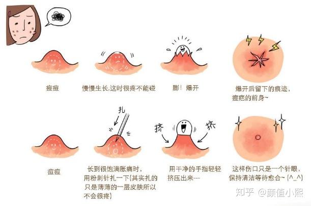 5招必杀技让你摆脱粉刺痘痘烦恼!