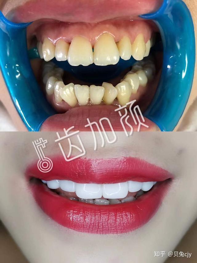 案例分享:牙齿不弃调整黄牙 牙齿不齐调整,从视觉上
