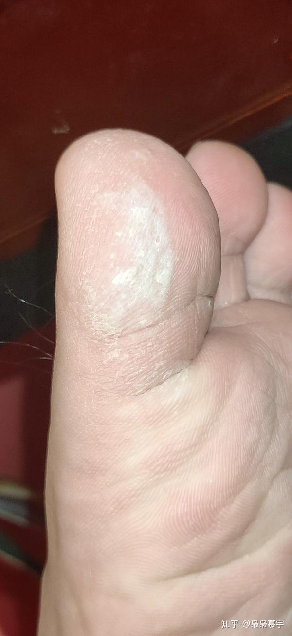 令人头疼的跖疣及我的治疗过程