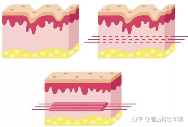 皮肤松垂垮 | 如何正确抗衰?别再交智商税了! - 知乎
