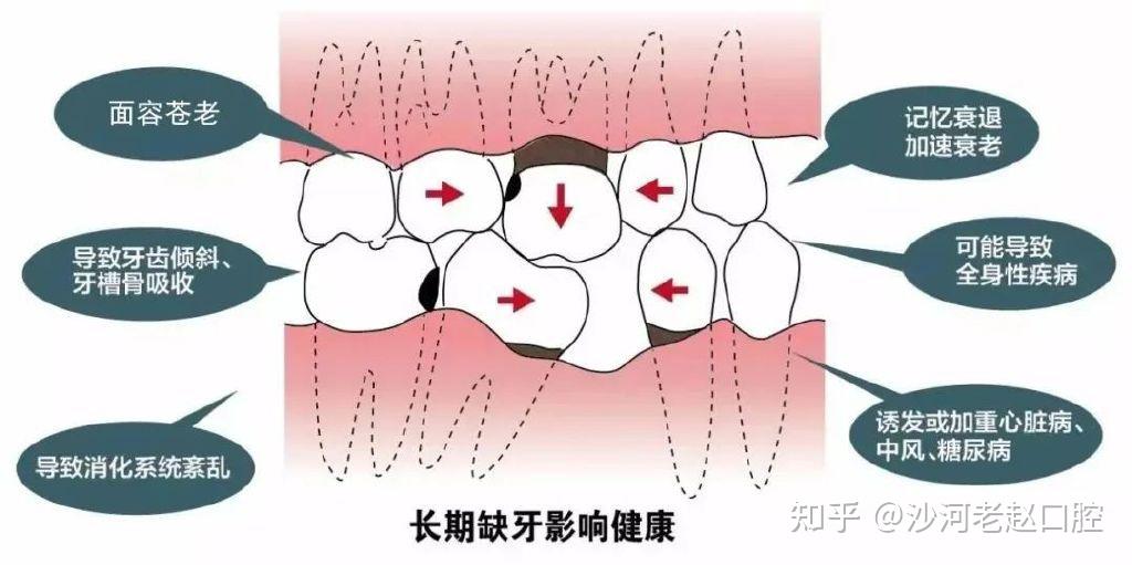 口腔科普缺牙的危害竟然这么大千万别拖