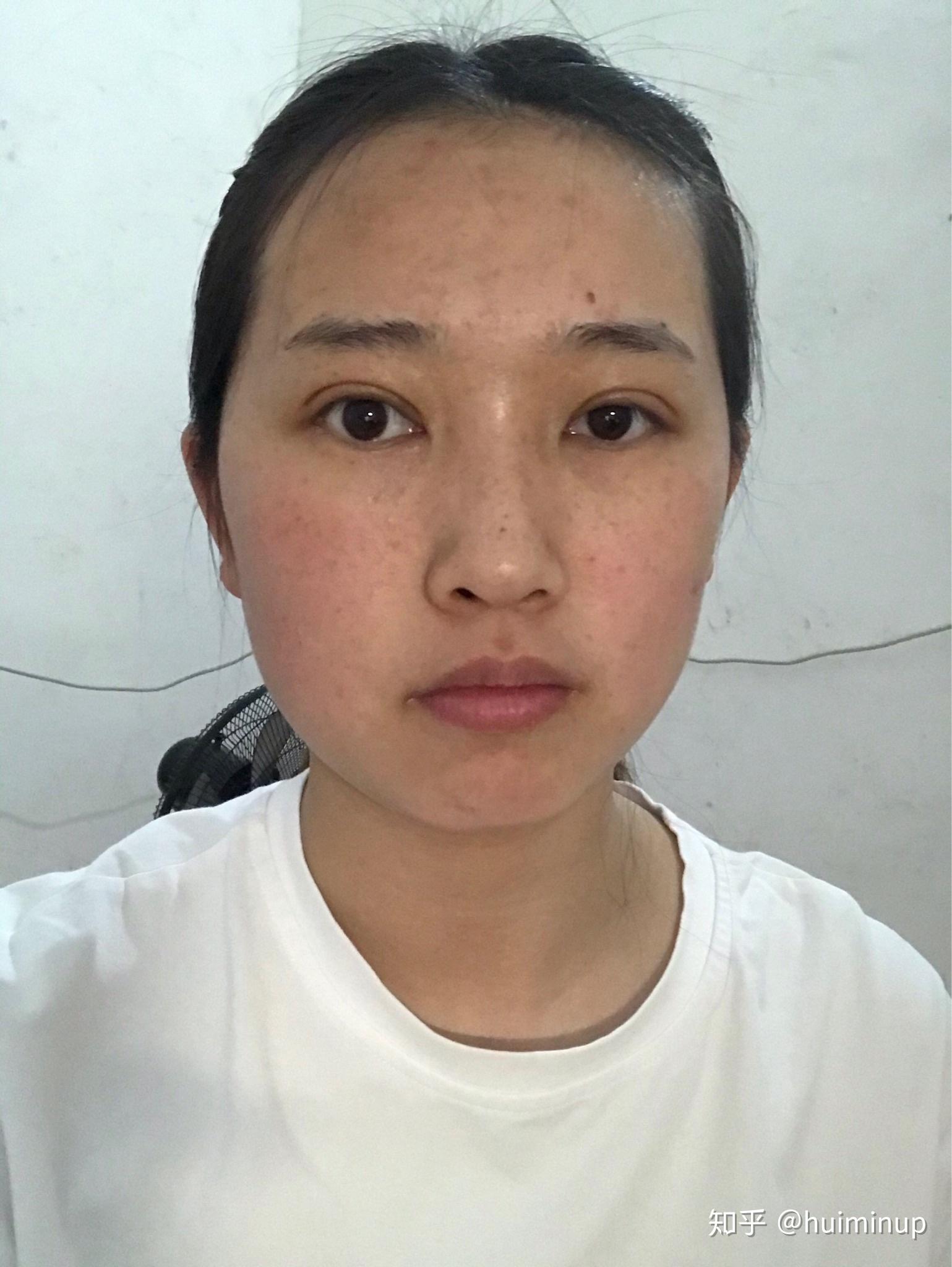 左右脸不对称怎么办带图