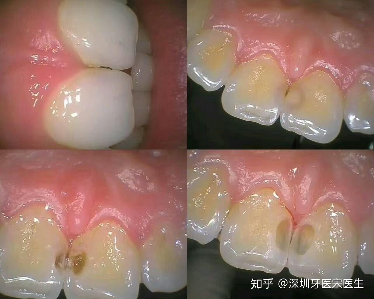 深圳补牙-右上门牙树脂充填案例分享 - 知乎