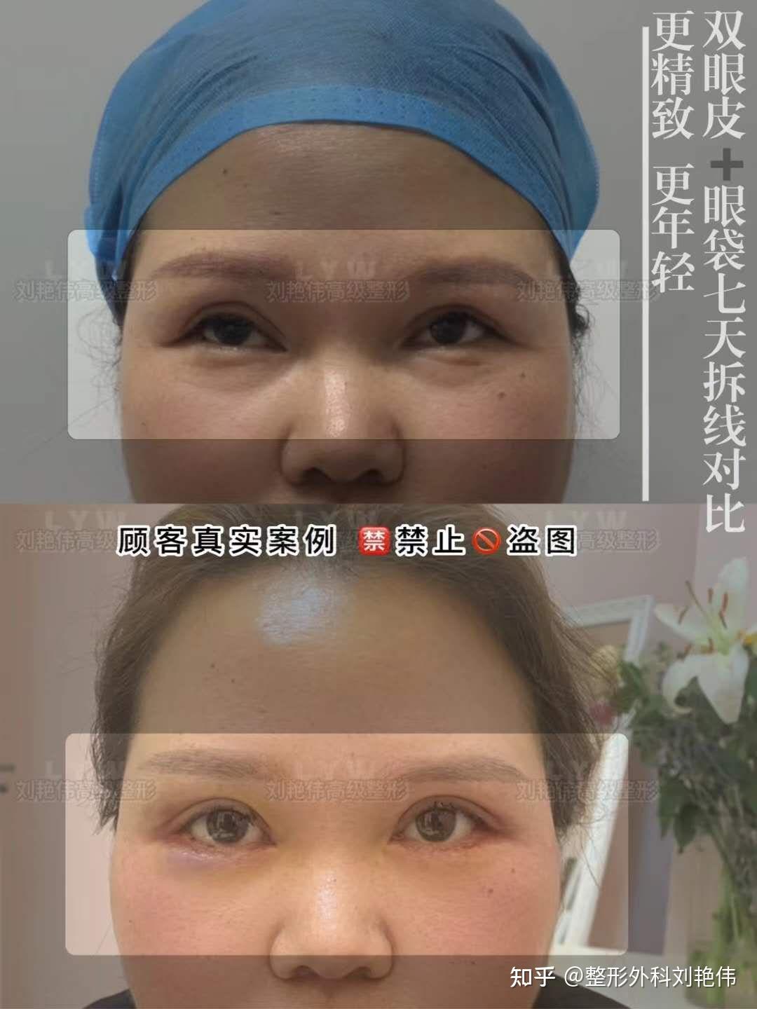 双眼皮修复、宽改窄_新氧-专业医美服务平台