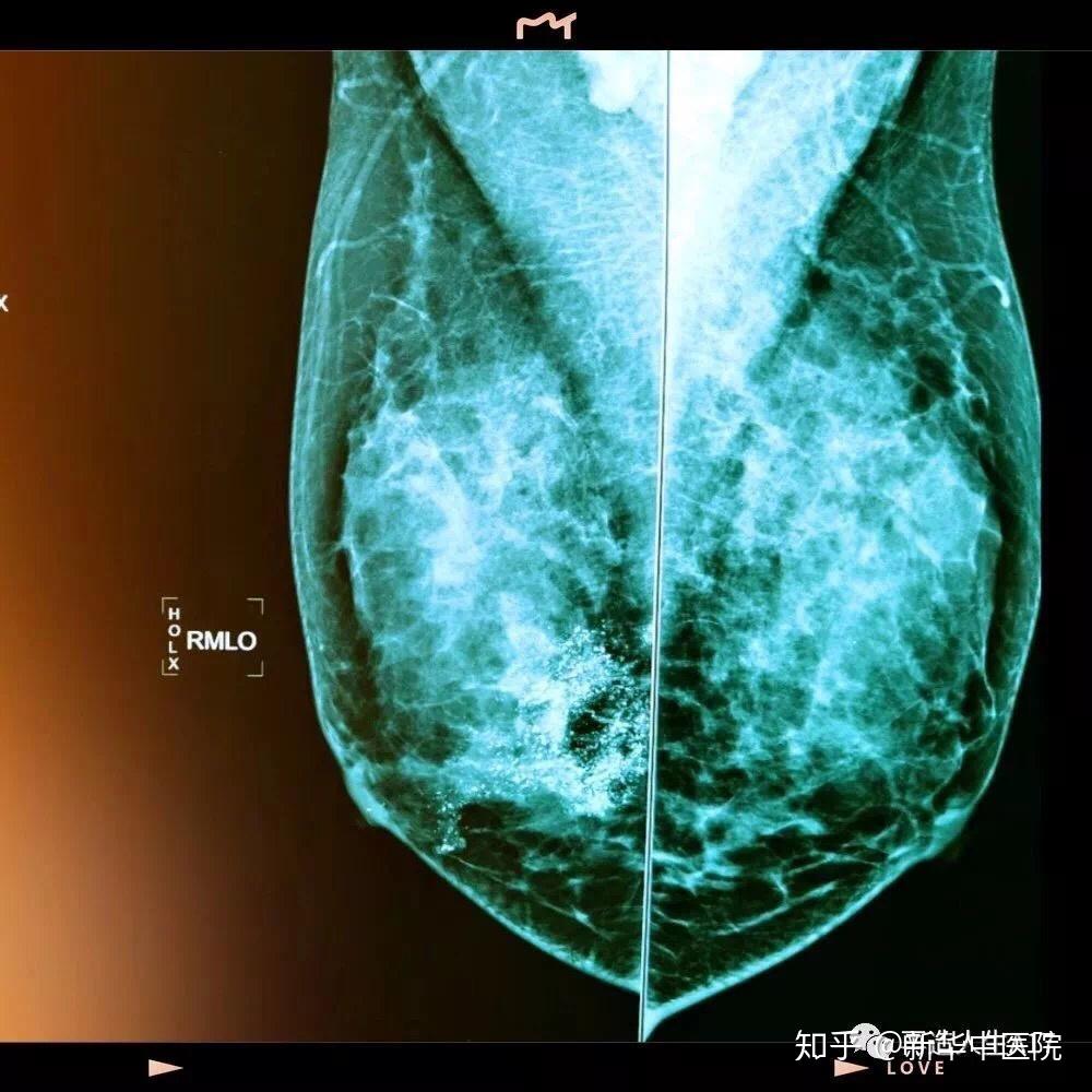 乳腺鈣化一般是通過乳腺鉬靶檢查發現的,表現為高密度的點狀影或者