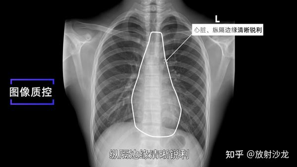 X线规范化检查 | 胸部正侧位摄影 - 知乎