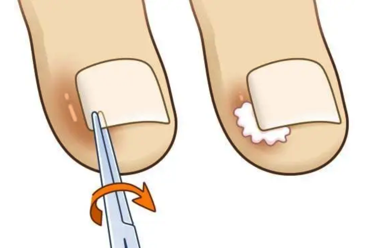 正确剪指甲,远离甲沟炎 - 知乎