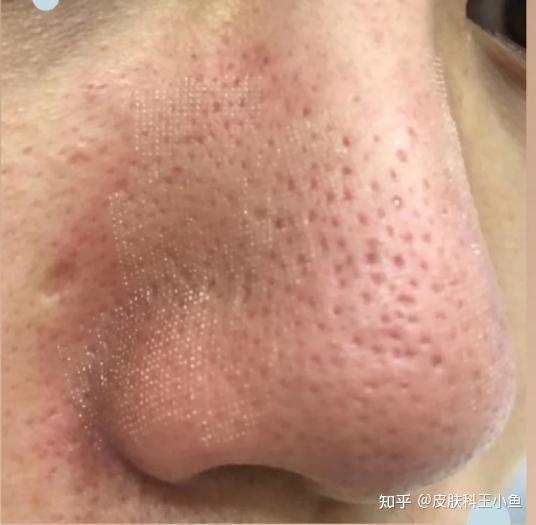 【黑头/ 大毛孔】皮肤科实习生去黑头自用总结,干货经验分享,全类型黑头一网打尽,告别草莓鼻! - 知乎