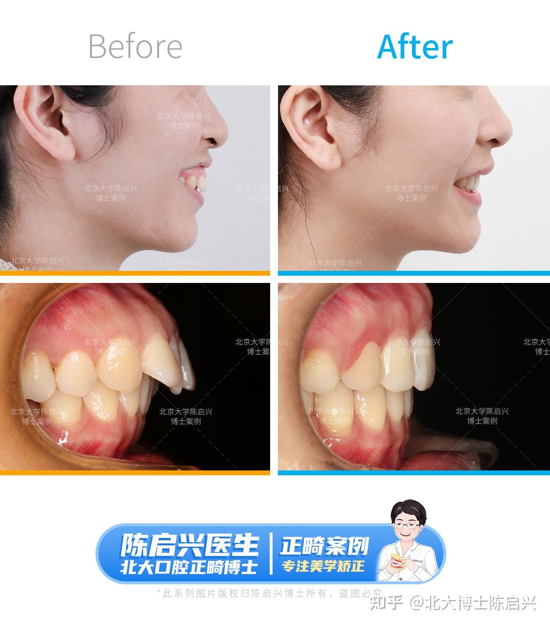舌侧矫正改善严重露龈笑,深覆盖深覆合 - 知乎