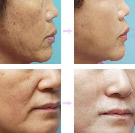 那除皱方式好要怎么选呢