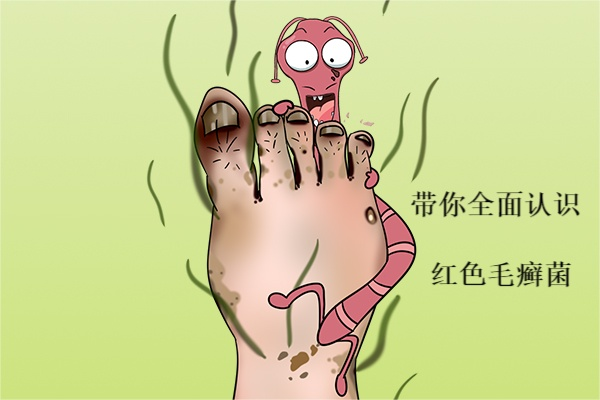 感染灰指甲的元凶如何才能彻底消灭