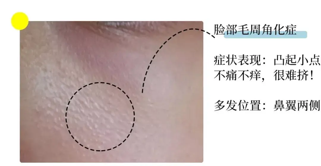 脸部鼻子皮肤鸡皮(鼻子两侧眼下鸡皮肤) 脸部鼻子皮肤鸡皮(鼻子两侧眼下鸡皮肤)