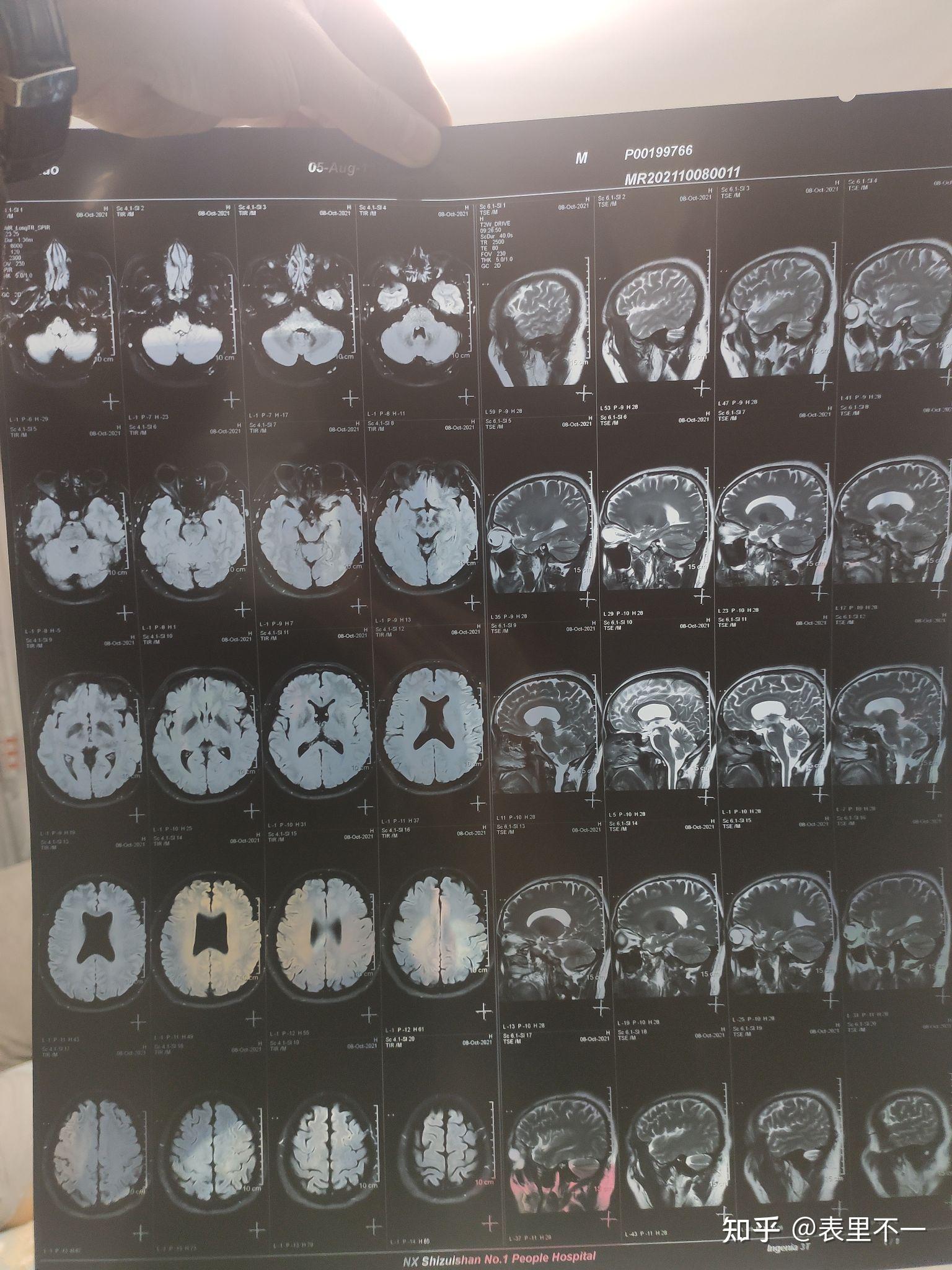 脑部核磁片子图片