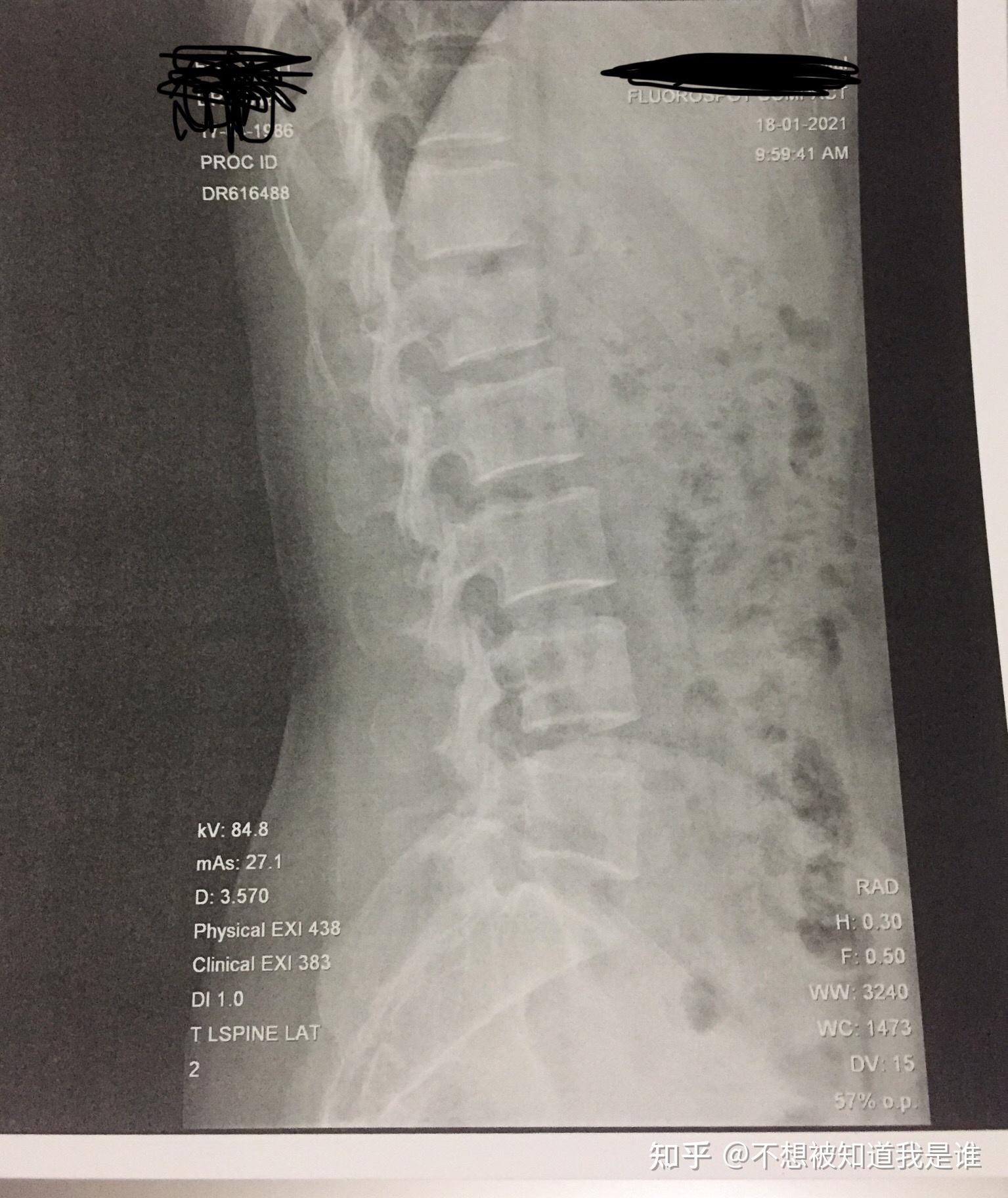 记录我(女,34岁)的腰椎l1压缩性骨折,尾椎骨折(保守治疗)整个恢复过程