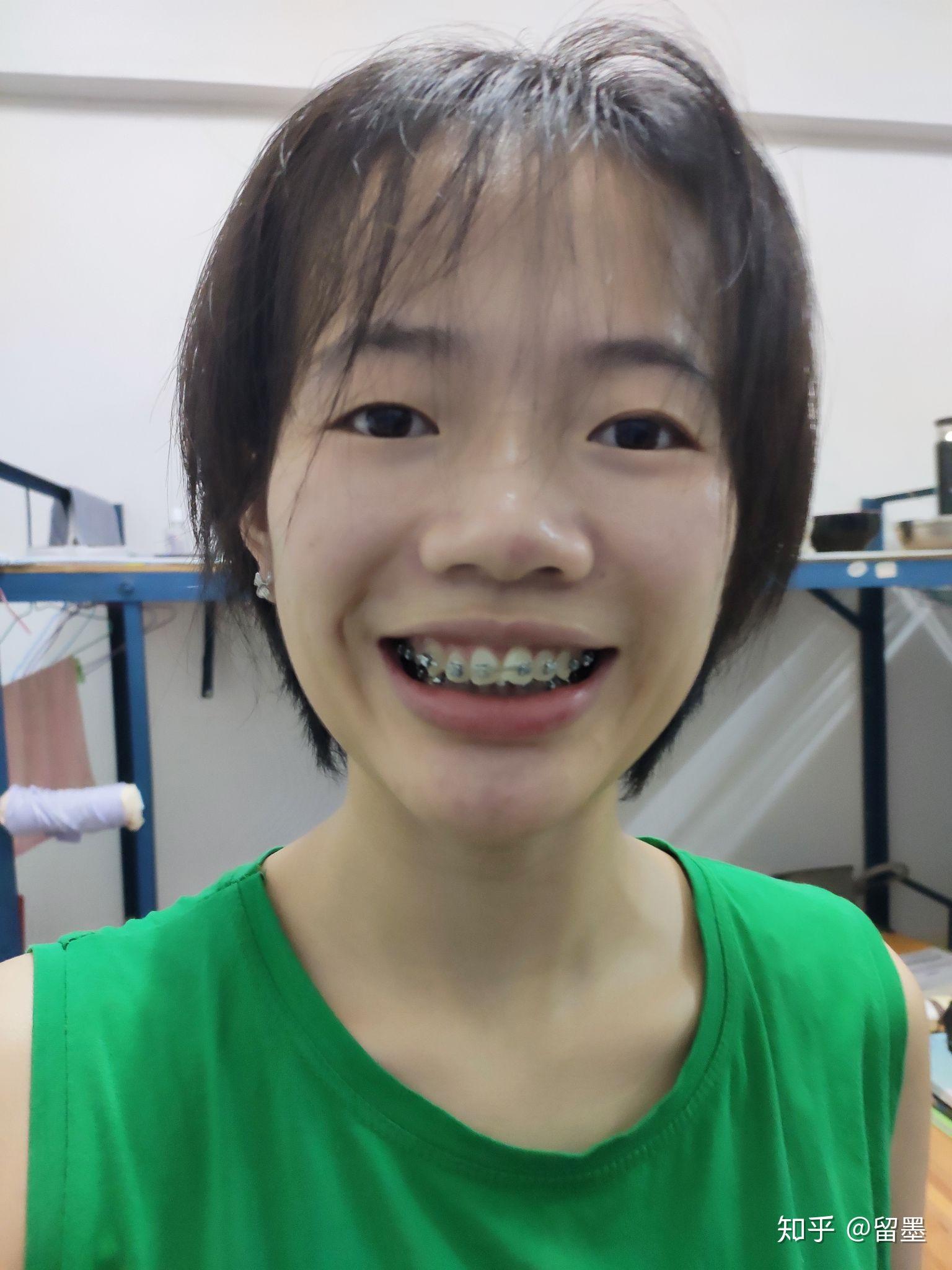 24岁深漂女青年箍牙全记录