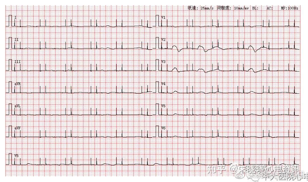 【 參考解析 】心電圖為為直線,僅可見起搏器信號【 解析過程 】分析