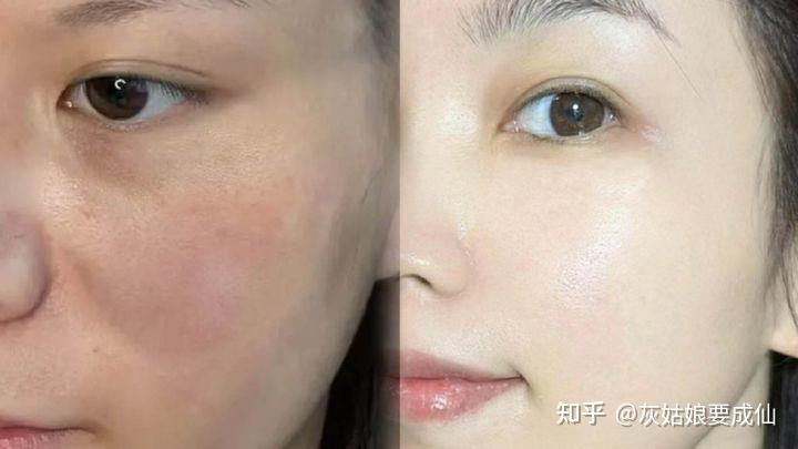女生如何在短期内变美?(去法令纹、去干纹、细纹) - 知乎