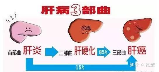 肝硬化還可以逆轉嗎出現了腹水又該怎麼辦