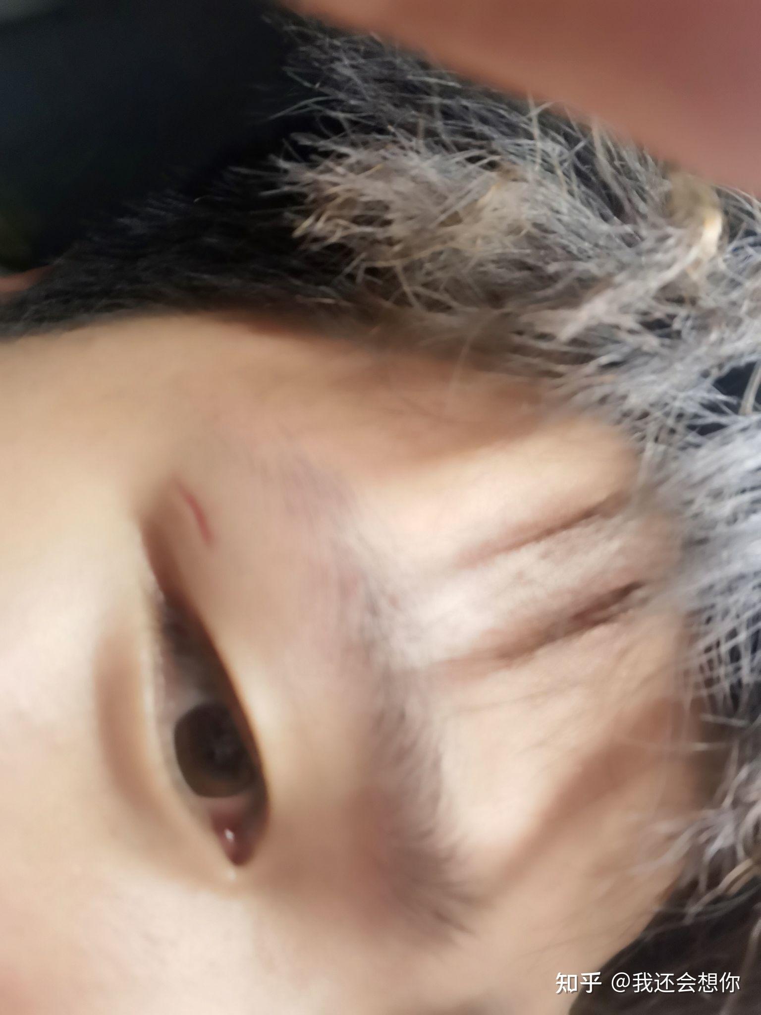 这种凹陷疤痕,用生长因子有用吗? - 知乎