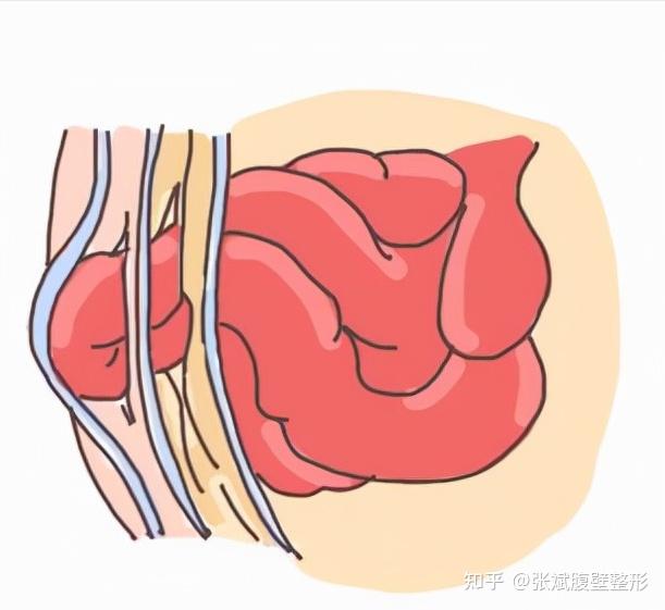 其中腹股溝疝發病率佔腹壁疝75%-90%,而男性腹股溝疝的發病率是女性的