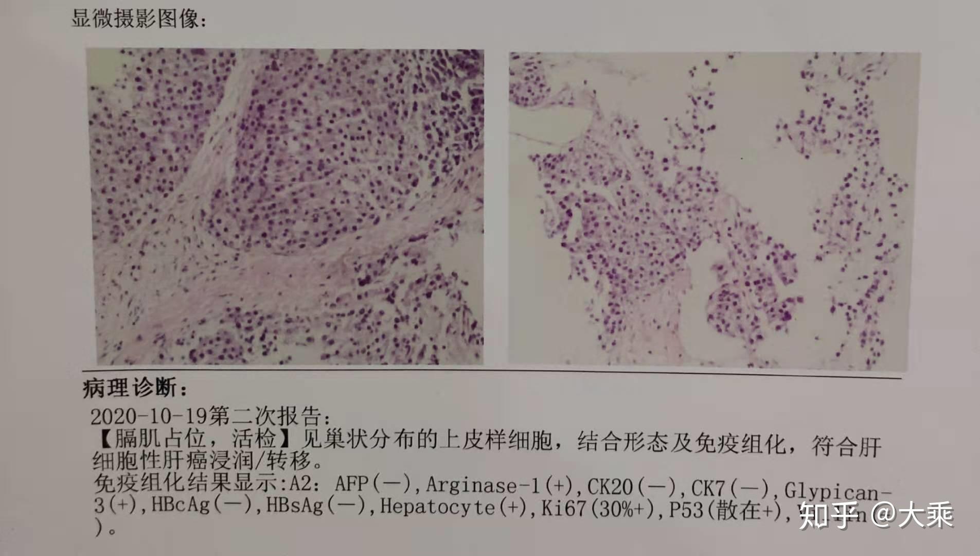 三、PET/CT-MR增强异机融合在原发性肝癌诊断中的使用价值|上海大学附属上海全景云医学影像诊断中心|全景医学影像