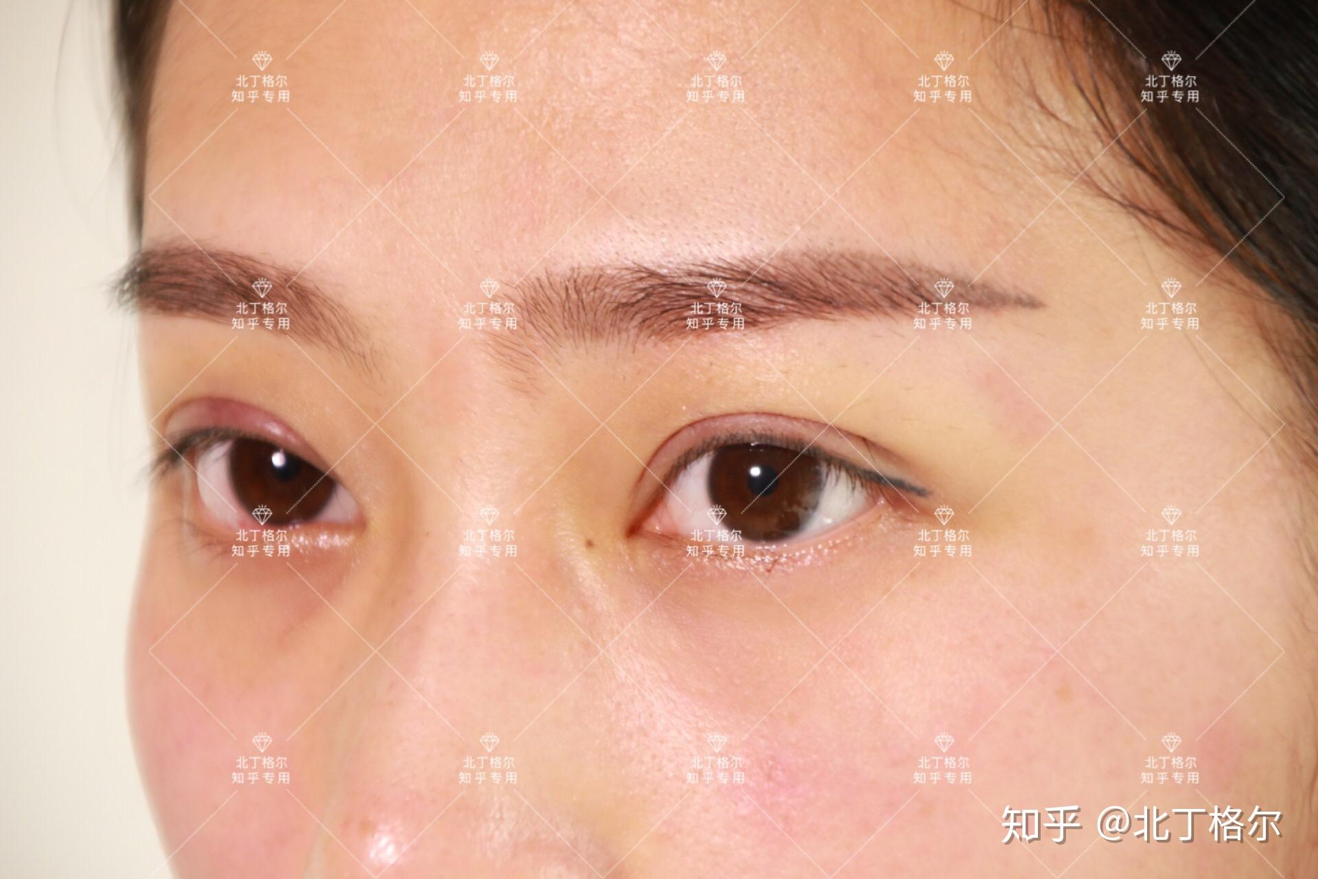自己适合几毫米一般亚洲人割双眼皮的宽度都在5mm~8mm稍微懂点的人