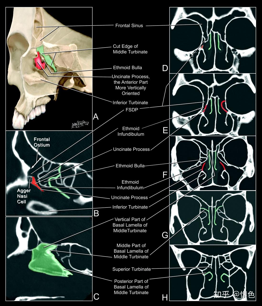 因為他倆和半月裂孔(semilunar hiatus),篩漏斗(ethmoid infundibulum