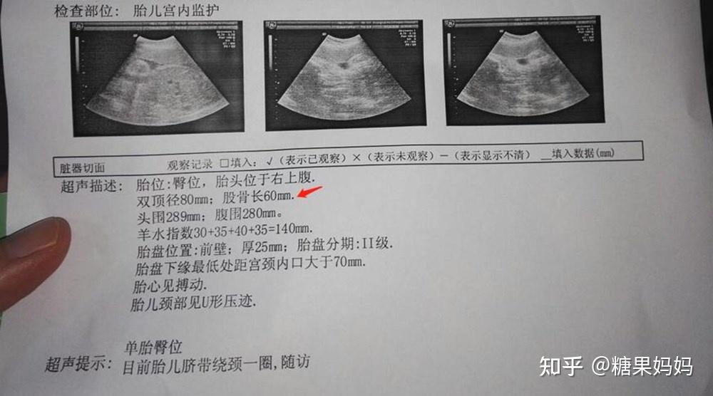 产检时胎儿股骨短