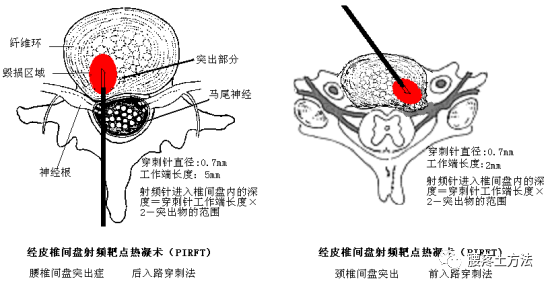 治疗腰椎间盘突出的十个方法