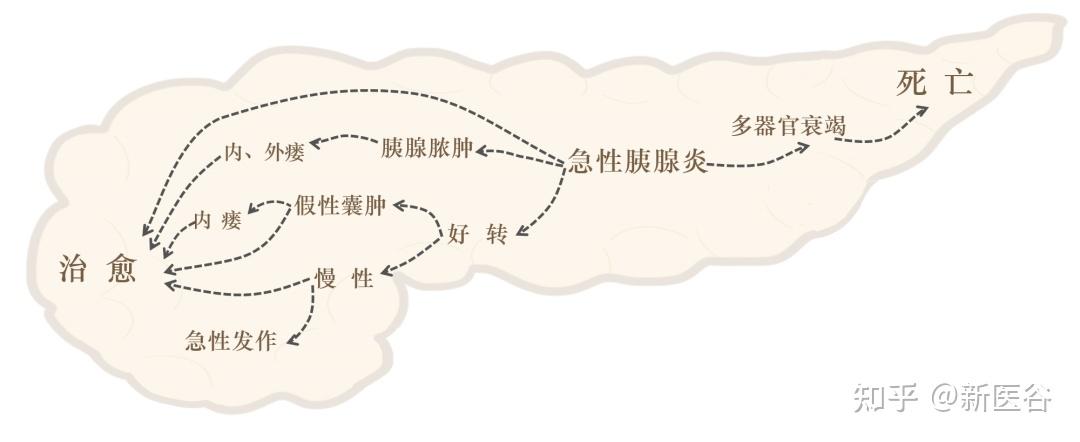 谷谷给你介绍急性胰腺炎