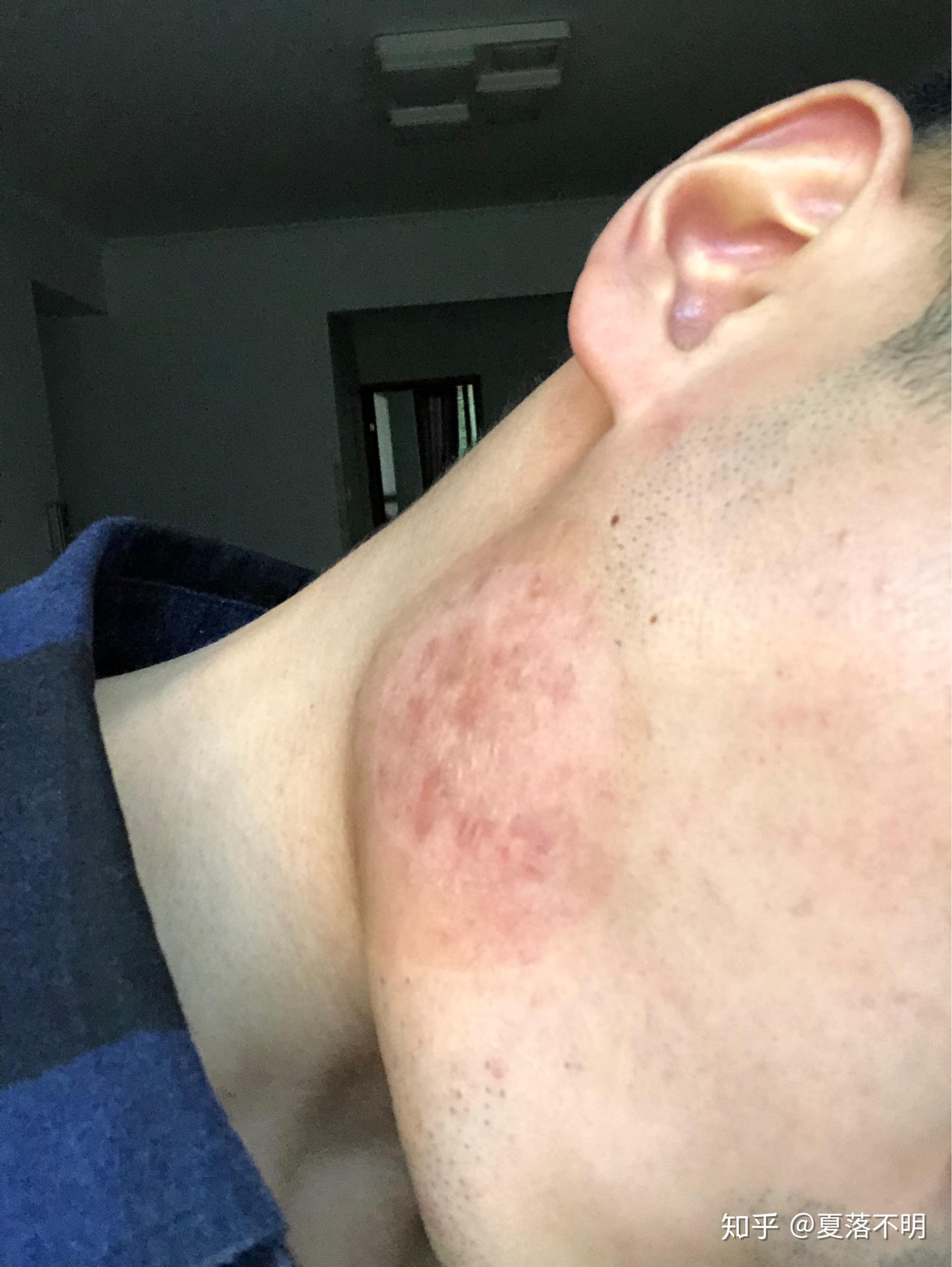 脸部疤痕疙瘩的治疗过程及走过的弯路给各位以借鉴吧