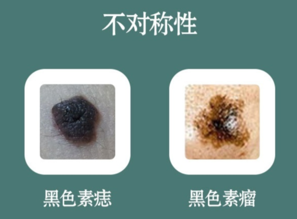 身上的痣是否会癌变？这5种情况要小心 - 知乎