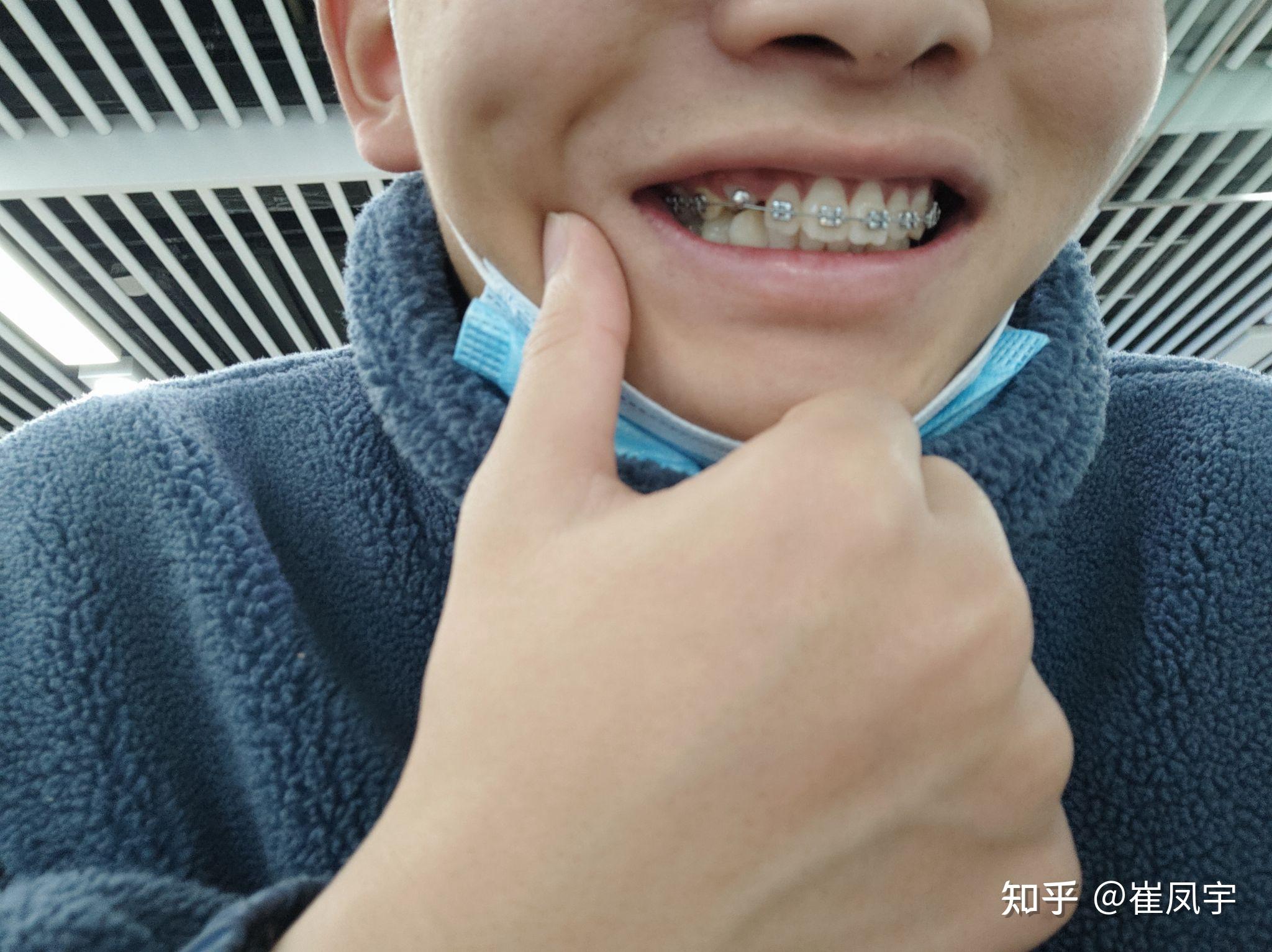 一次埋伏牙牵引的经历!