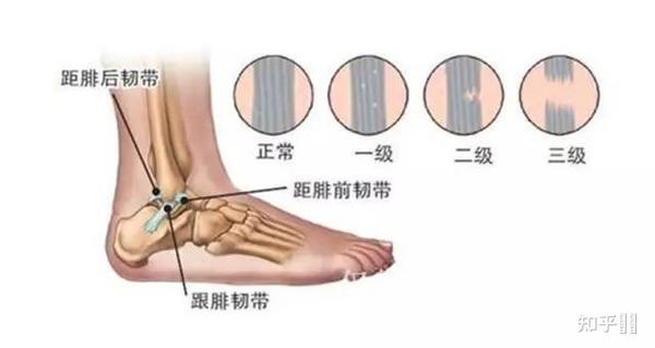 脚踝扭伤康复用什么牌子的护踝比较好?
