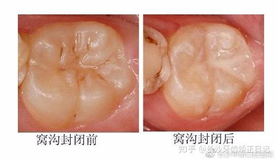 后牙上有黑线是色素还是蛀牙