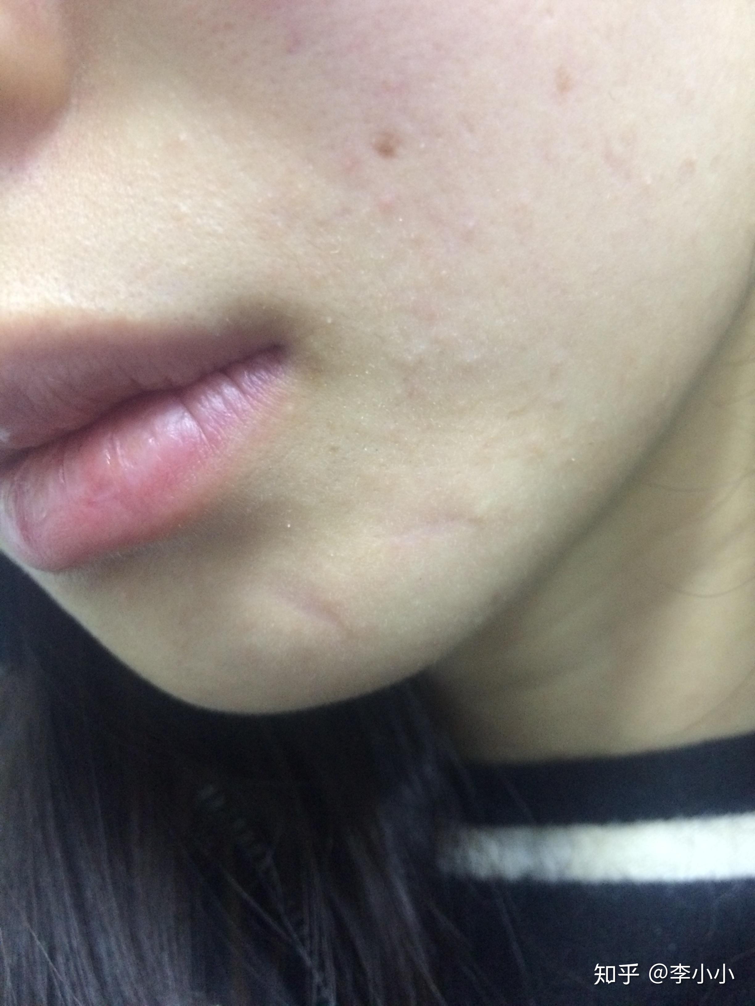 华西手术祛痣记录